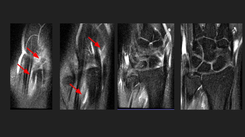 Figure 3 for case extensor pollicis longus tendon ( RID2378 )